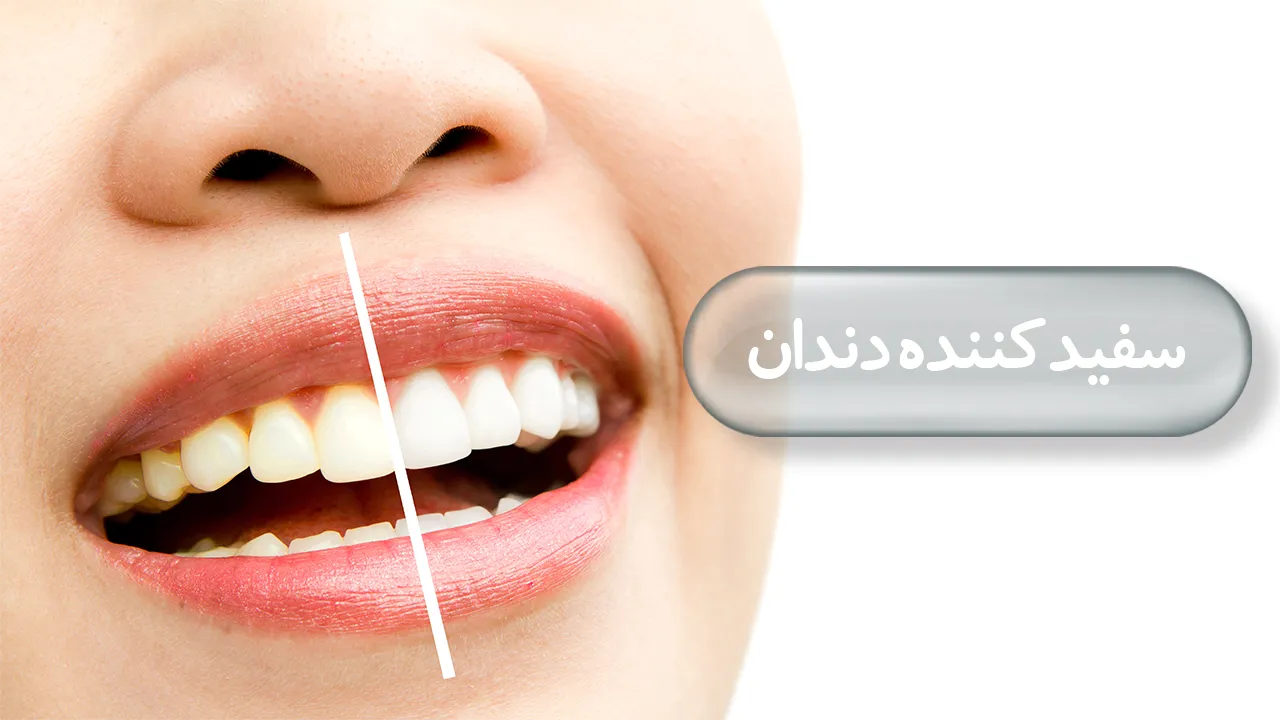 سفید کننده دندان